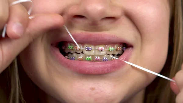Girl with braces brushing your teeth with dental floss closeup. A girl with colored braces on her teeth keeps her teeth clean. — Stock Photo, Image