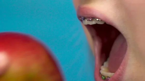 Teenager girl with braces on her teeth eats a red apple on a blue background. Girl with colored braces bites off an apple closeup. — Stock Photo, Image