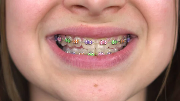 Teen girl with braces smiling close-up. Girl with colored braces on her teeth. — Stock Photo, Image