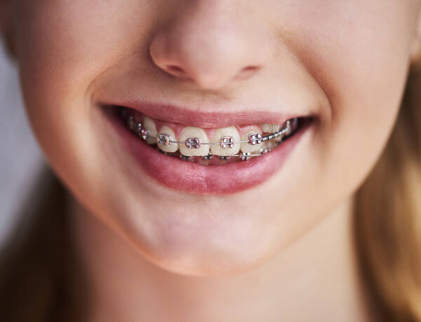 Close up of teeth with braces 