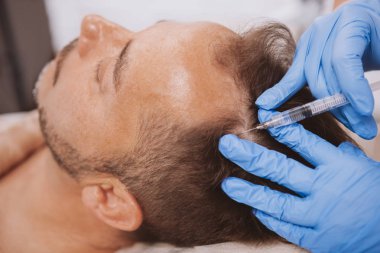 Balding man getting hairloss treatment injections