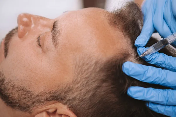 Balding man getting hairloss treatment injections — Stock Photo, Image