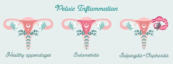 Women health - Pelvic Inflammation. Anatomical scheme of Endometritis, Oophoritis, Salpingitis. Gynecological Problems — Stock Vector