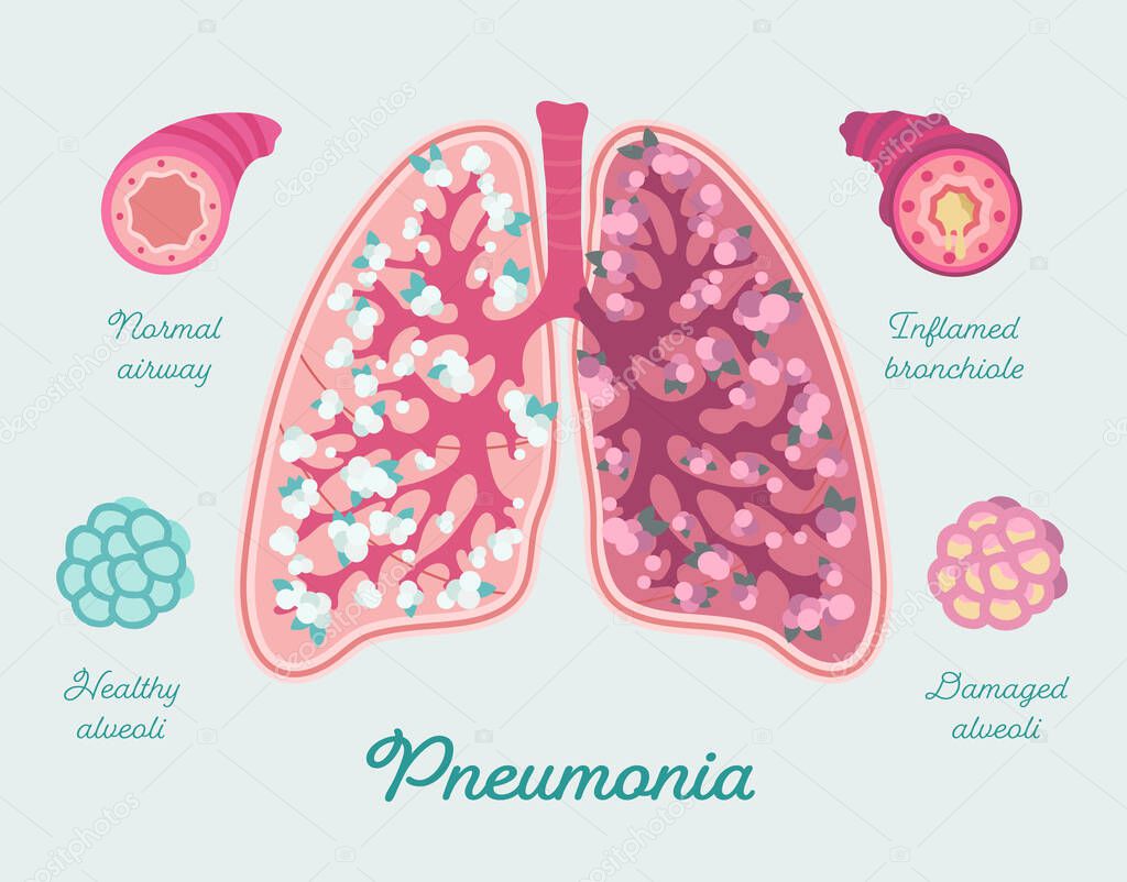 Pneumonia in human lungs. Inflammation lungs - including due to COVID-19. Respiratory diseases