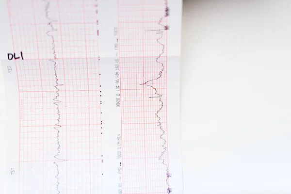 stock image Cardiogram of the baby before birth