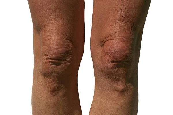 Die Knie Des Mannes Von Vorne Betrachtet — Stockfoto