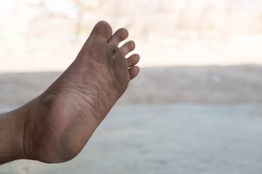 Ayak closeup bir enfeksiyonu mantar neden ayak.