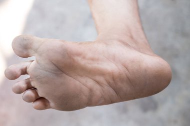 Ayak closeup bir enfeksiyonu mantar neden ayak.