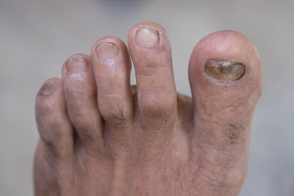 Ayak Closeup Bir Enfeksiyonu Mantar Neden Ayak — Stok fotoğraf