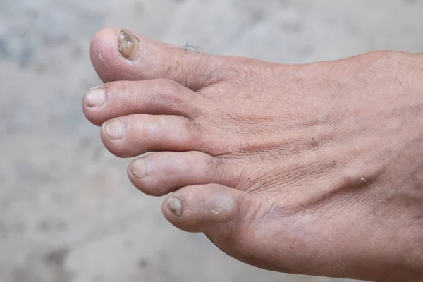 Closeup Foot Infection Feet Caused Fungus — Stock Photo, Image