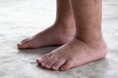 Kaşıntılı dermatit atopik bebek ayak. Yara Infected kadar kapatın. Sol bacak, yara açtı.