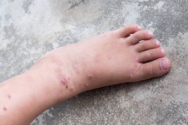 Kaşıntılı dermatit atopik bebek ayak. Yara Infected kadar kapatın. Sol bacak, yara açtı.