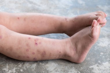 Kaşıntılı dermatit atopik bebek ayak. Yara Infected kadar kapatın. Sol bacak, yara açtı.