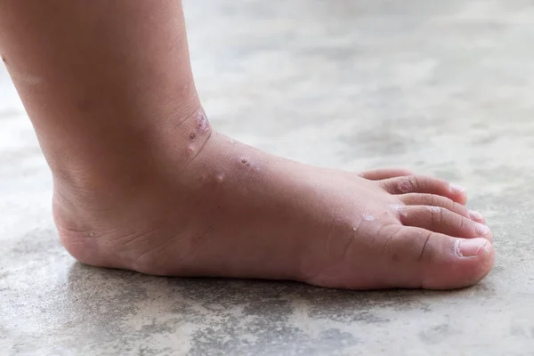 Kaşıntılı Dermatit Atopik Bebek Ayak Yara Infected Kadar Kapatın Sol — Stok fotoğraf