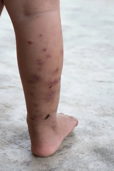 Dermatitis Punzante Pie Bebé Atópico Herida Infectada Herida Abierta Pierna — Foto de Stock