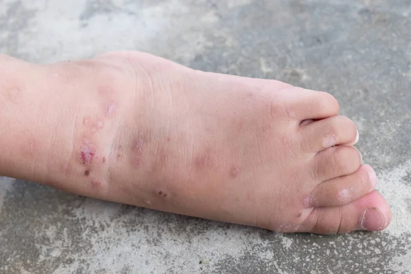 Dermatitis Punzante Pie Bebé Atópico Herida Infectada Herida Abierta Pierna — Foto de Stock