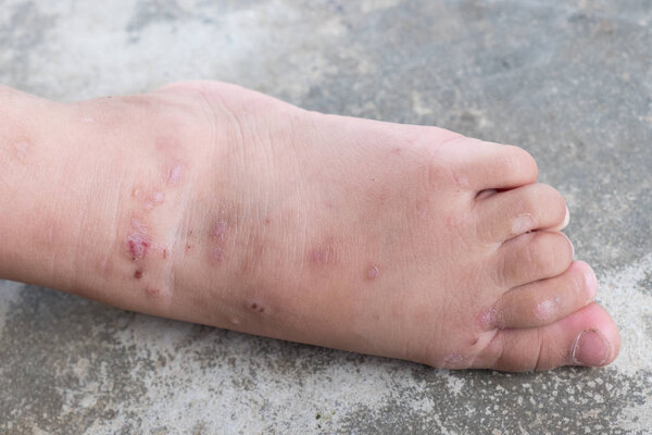 Itchy dermatitis atopic baby foot. Close up Infected wound.Opened wound at left leg.