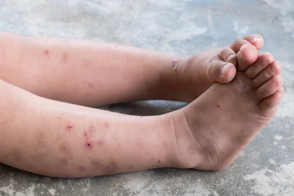 Dermatitis Punzante Pie Bebé Atópico Herida Infectada Herida Abierta Pierna — Foto de Stock