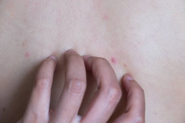 Akne, dermatit. Arka yüzündeki sivilce.