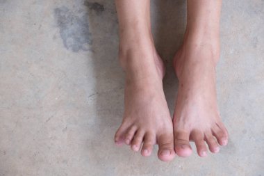 Kucak ayak veya düz taban. Topuklar ve varisli damarlar portre sağlık ve ayak bakımı, kırık.