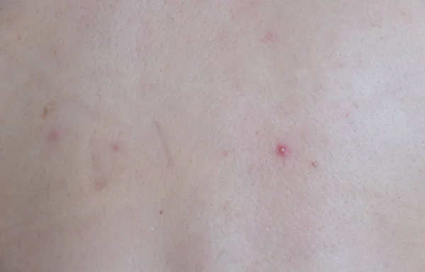 Acné Dermatitis Acné Espalda — Foto de Stock