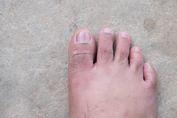 Lap Feet Flat Foot Saúde Cuidados Com Pés Fechar Calcanhares — Fotografia de Stock