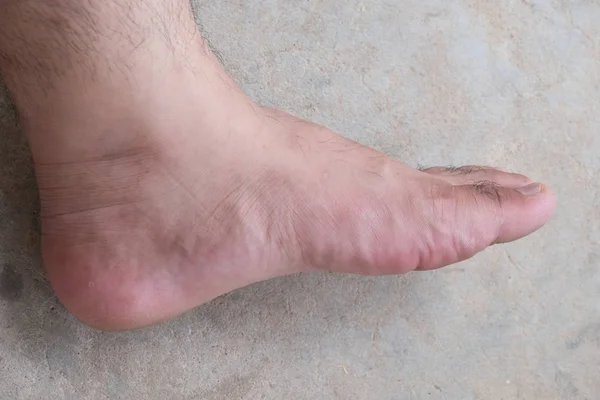 Lap Feet Or Flat Foot. Health & Foot Care, Closeup cracked heels and varicose veins.