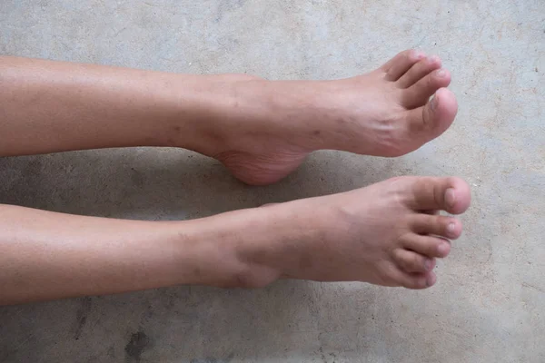 Lap Feet Or Flat Foot. Health & Foot Care, Closeup cracked heels and varicose veins.