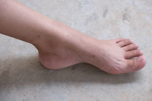 Lap Feet Flat Foot Saúde Cuidados Com Pés Fechar Calcanhares — Fotografia de Stock