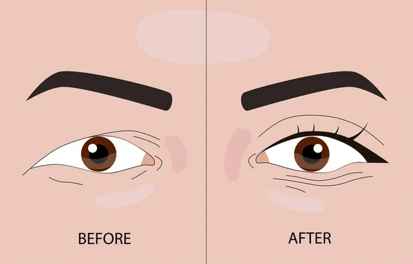 Double Eyelid Surgery Vector Illustration Eps10 — Stock Vector