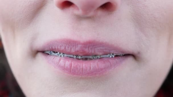Mladá dívka se složenými rovnátka na zuby a usmívá se. Zavři to. Zuby jsou špinavé — Stock video