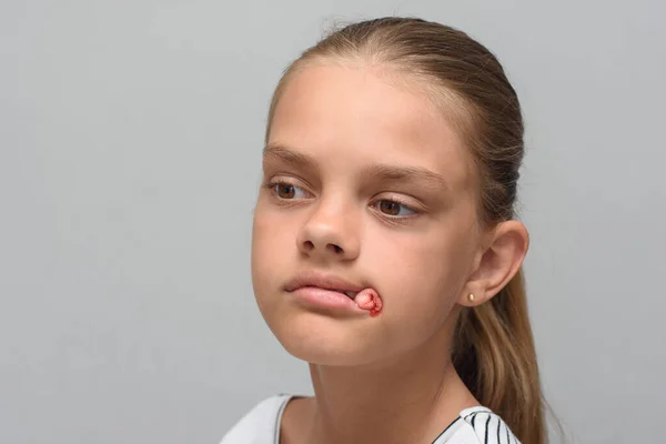 Bloody Swab Sticks Out Mouth Ten Year Old Girl Tooth — Stock Photo, Image