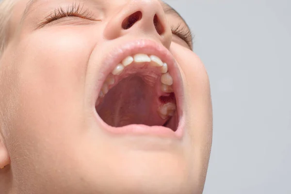 Well Extraction Milk Tooth Girl Mouth — Stock Photo, Image