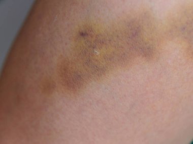 Yaralı bacak, Aile içi şiddet kavramı görünümü kapatın