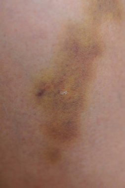 Yaralı bacak, Aile içi şiddet kavramı görünümü kapatın