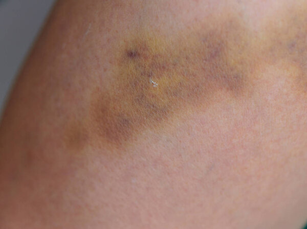 Крупный план ранения ноги, концепция домашнего насилия
