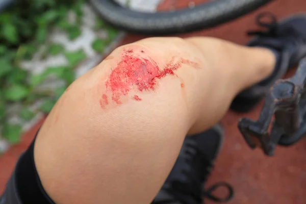 Lesiones Bicicleta Ciclista Mujer Cayó Mientras Pedaleaba Rodilla Lesionada — Foto de Stock