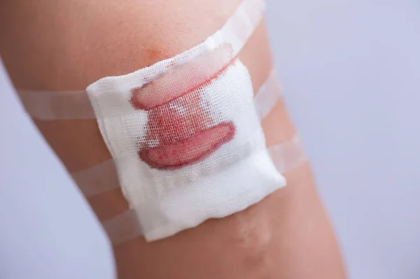 ガーゼと血液で削られた人間の膝のクローズアップ — ストック写真