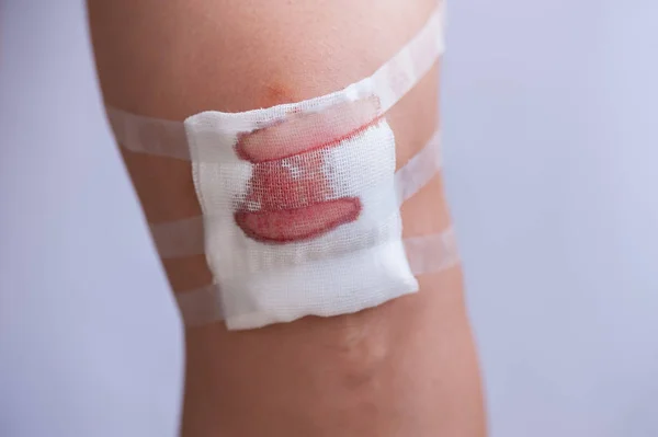 Close Scraped Human Knee Gauze Blood — Stock Photo, Image