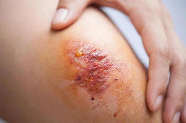 女性の膝の新鮮な傷のクローズアップ — ストック写真