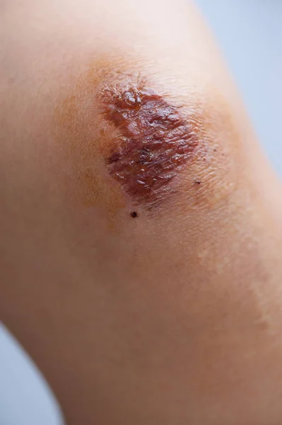 女性の膝の新鮮な傷のクローズアップ — ストック写真