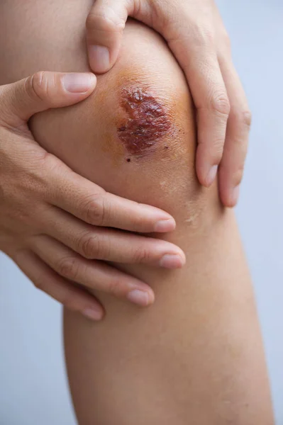 Close Fresh Wound Female Knee — Stock Photo, Image
