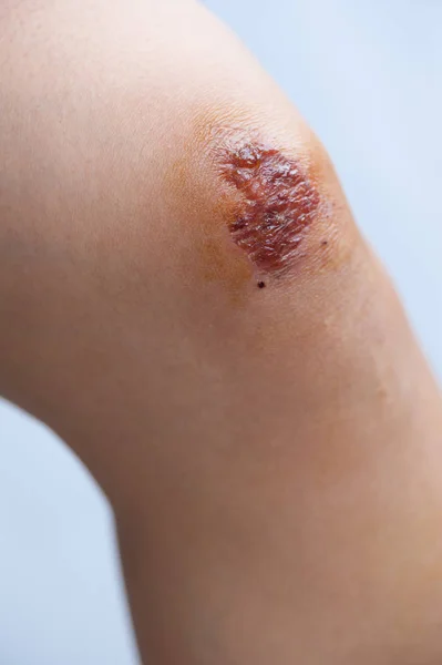 女性膝关节新鲜伤口的特写 — 图库照片
