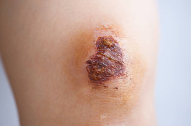 Asya kadın diz üzerinde yara ve kabuk (eschar)