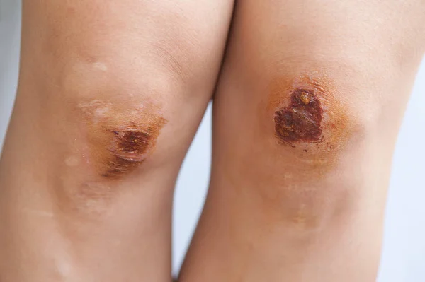 Bike Injury Wound Asian Female Knees — Stock Photo, Image