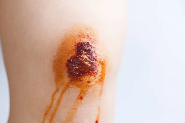 膝の傷跡とかさぶた エシャール — ストック写真