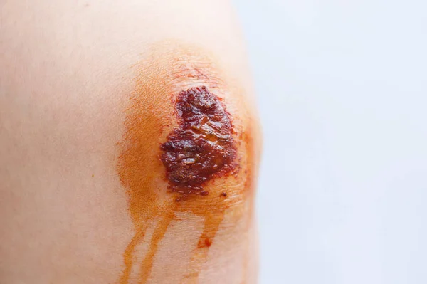 Scar Scab Eschar Asian Female Knee — Stock Photo, Image