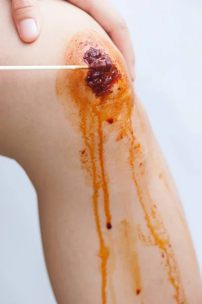 自転車の負傷した膝のヨウドファーで綿棒を消毒 — ストック写真
