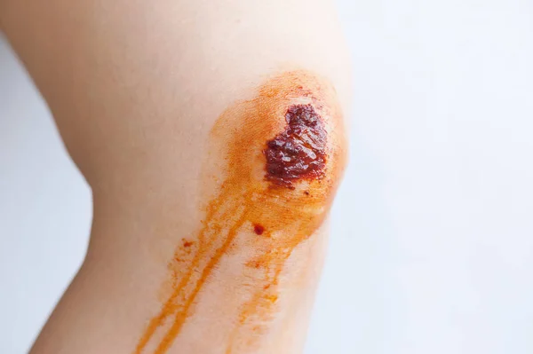 膝の傷跡とかさぶた エシャール — ストック写真