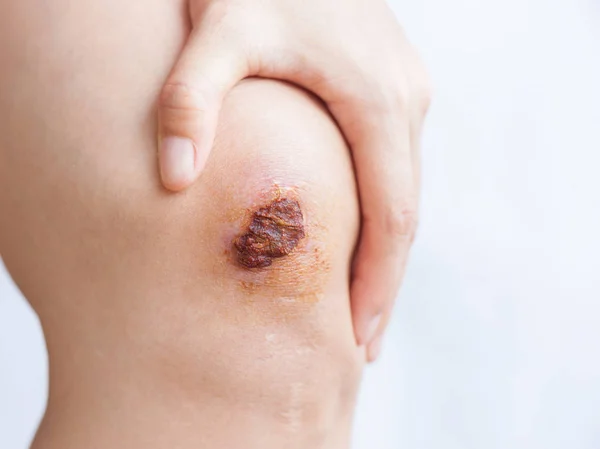 Scar Scab Eschar Female Knee — Stock Photo, Image